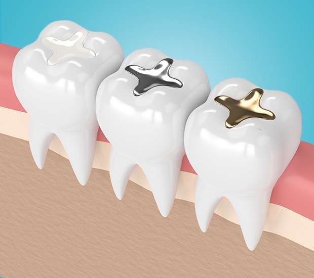 North Hollywood Composite Fillings