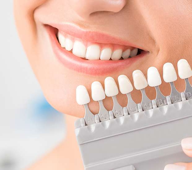 North Hollywood Dental Veneers and Dental Laminates